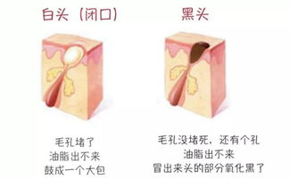 辨別黑頭與閉口，黑頭儀的正確使用與誤區(qū)